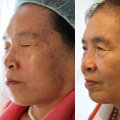 Facial Peels: Exploring Non-invasive Age-Reversing Treatments and Solutions