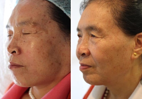Facial Peels: Exploring Non-invasive Age-Reversing Treatments and Solutions